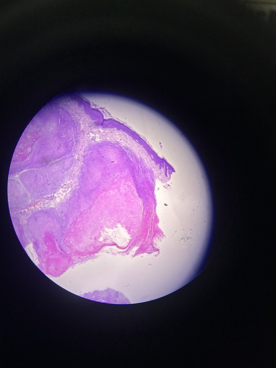 Simrangil128's tweet photo. Lesion at angle of mouth https://t.co/W9UZg2wipY