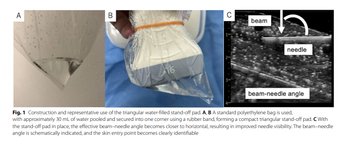 cvirendo's tweet photo. A low-cost triangular water-filled stand-off pad to improve needle visibility in ultrasound-guided procedures

https://t.co/zDVLjiBGjY https://t.co/OH0RoGayiI