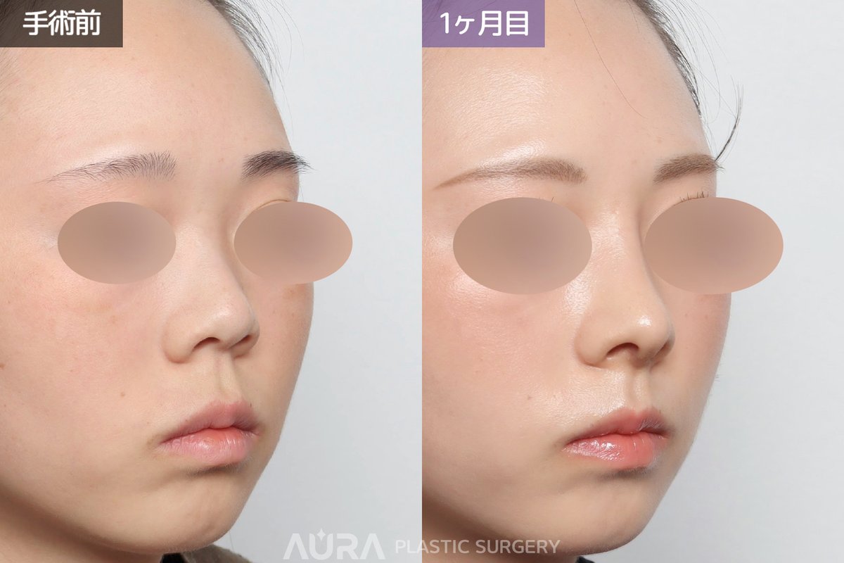 auraps2024's tweet photo. ✧ ｡ﾟ ⊹˖AURA BEFORE&AFTER ˖ ⊹ ﾟ｡ ✧

【手術内容】鼻筋＋鼻先＋団子鼻矯正＋陥没鼻柱矯正＋鼻孔下げ矯正＋鼻唇角矯正（短い鼻）＋鼻柱基部突出＋機能鼻矯正

鼻づまりと短くアップノーズによって人中が長く見えることをお悩みでご来院されたお客様です。
ご来院時のCT検査では、鼻中隔弯曲症と下鼻甲介肥大が強く認められたため、機能改善を目的として同時に矯正を行いました。また、CT上では鼻中隔軟骨が非常に小さく、大きく湾曲していたため、主な移植材料として肋軟骨を使用し、手術を行いました。
全体的に短くアップノーズになっていた鼻は、軟骨と皮膚を無理な緊張がかからないよう丁寧に剥離・延長し、自然な位置まで下げました。また、陥没していた鼻柱をできる限り前方へ出すことでACRを整え、人中が長く見える印象も改善しています。
横顔では、陥没していた鼻柱基部を前方へ出すことで中顔面の陥没感や口元の突出感を和らげ、さらに自然な高さのシリコンプロテーゼを使用することで、すっきりとした自然な直半ラインに仕上げました。

公式LINE：https://t.co/pMc2bkYBvU

 #韓国整形 #チュ先生 #ペク先生 #鼻初手術 #鼻再手術 #アウラ美容整形 #アウラ美容外科