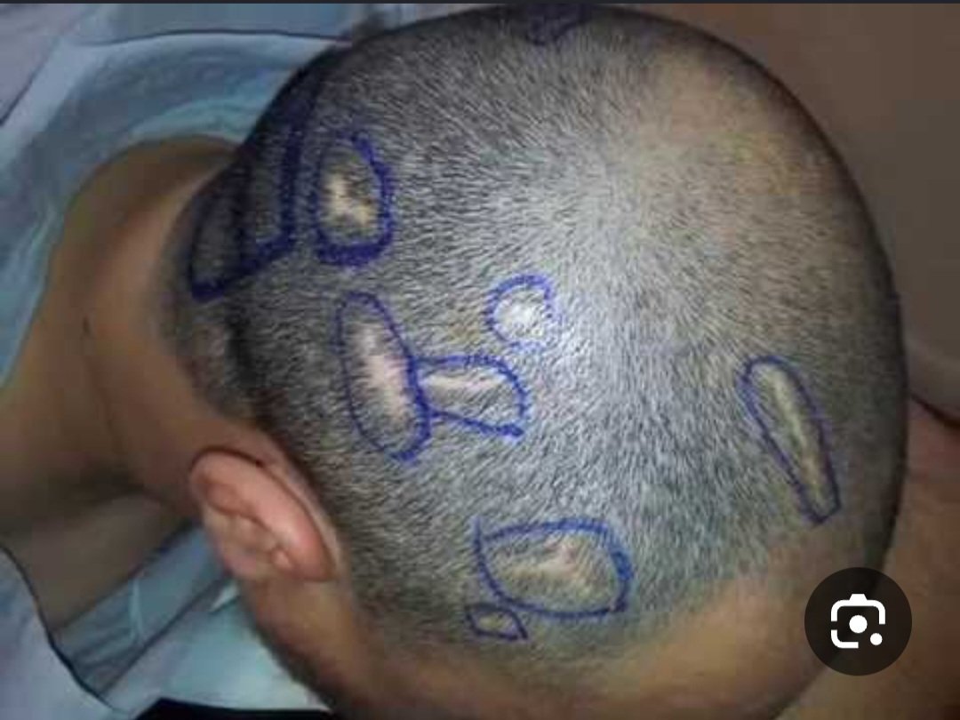 saud68087's tweet photo. وصريحة (تخاطب العقل والمنطق)
عند طفل👶(مرض غير المعروف)
​الكي بالنار لعلاج متلازمة داون؟ جهل طبي وجريمة بحق الطفولة! 🛑
​متلازمة داون خلل جيني طبيعي وليس مرضاً يُشفى بالحرارة والوسم. تعريض الطفل لهذا الألم يتسبب في:
​تشوهات جسدية دائمة في الرأس والجسد.
​عقد نفسية وخوف مستمر يدمر حياة الطفل.
​الوعي هو العلاج، والرحمة هي المبدأ. حماية أطفالنا مسؤولية الجميع. 🤝
​#الوعي_الصحي #حقوق_الطفل #متلازمة_داون
#زمان_الطيبين