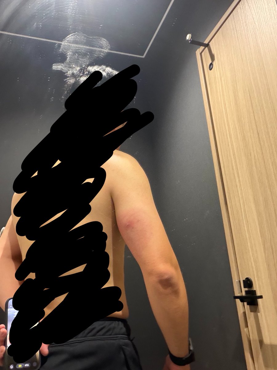 jingzosan's tweet photo. リブレをつけていらっしゃる方にご質問です。2日ほど前にリブレの数値が上がらなくなり、交換で外すと腫れ上がっていました。診察はしてもらって化膿は無さそうなのですが、汗かいたりしてこういうこと、皆さんありましたか？
#1型糖尿病 
#フリースタイルリブレ https://t.co/dPl4GvjB6O