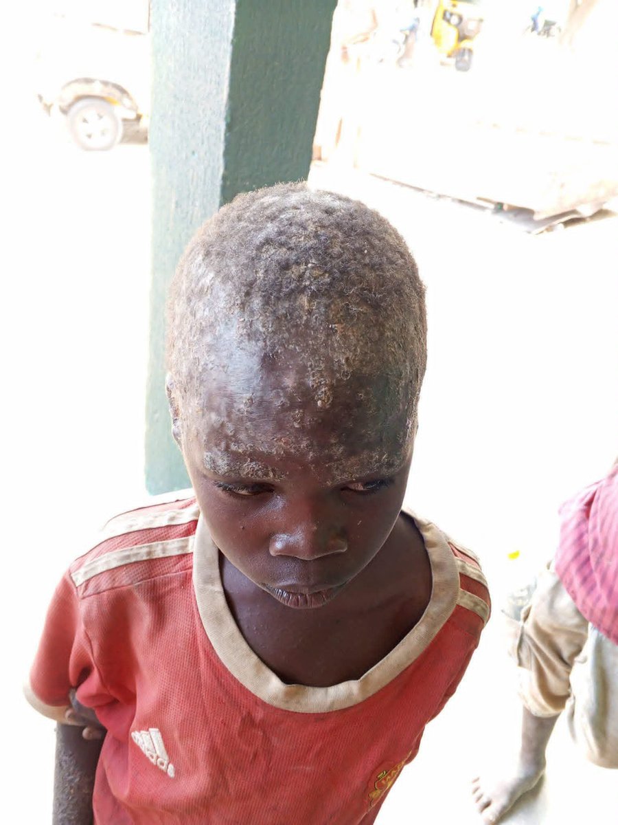 MujahidSSaad's tweet photo. What is the cause of this skin disease? 💔🥲🤌🏼 https://t.co/IBfBpk7F9t