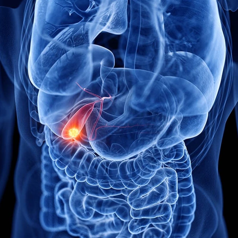 dogalmaxx's tweet photo. Ana ak��m  gastroenteroloji, safra kesesi hastalıklarını (safra taşları, iltihaplar ve yağ sindirememe) genellikle "aşırı yağ tüketimine, genetiğe veya yaşlanmaya" bağlar ve nihai çözüm olarak sıklıkla safra kesesinin ameliyatla alınmasını (kolesistektomi) önerir.

Ancak safra ++ https://t.co/3oKZi4The4