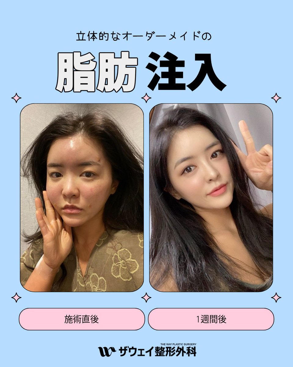 thewayps's tweet photo. 合コン注射に続く✨NAVER AI pick！脂肪注入

韓国代表ポータルNAVERで、
「脂肪注入有名な所」「脂肪注入おすすめ」と
検索すると？ザウェイ美容外科が登場🔍

自然なボリューム感で、
理想バランスへ導く脂肪注入☺️

ザウェイで自然美へ❤

▶LINEで相談OK👉https://t.co/CU8AcjU2X4

#韓国脂肪注入 https://t.co/nbunmHrKRK
