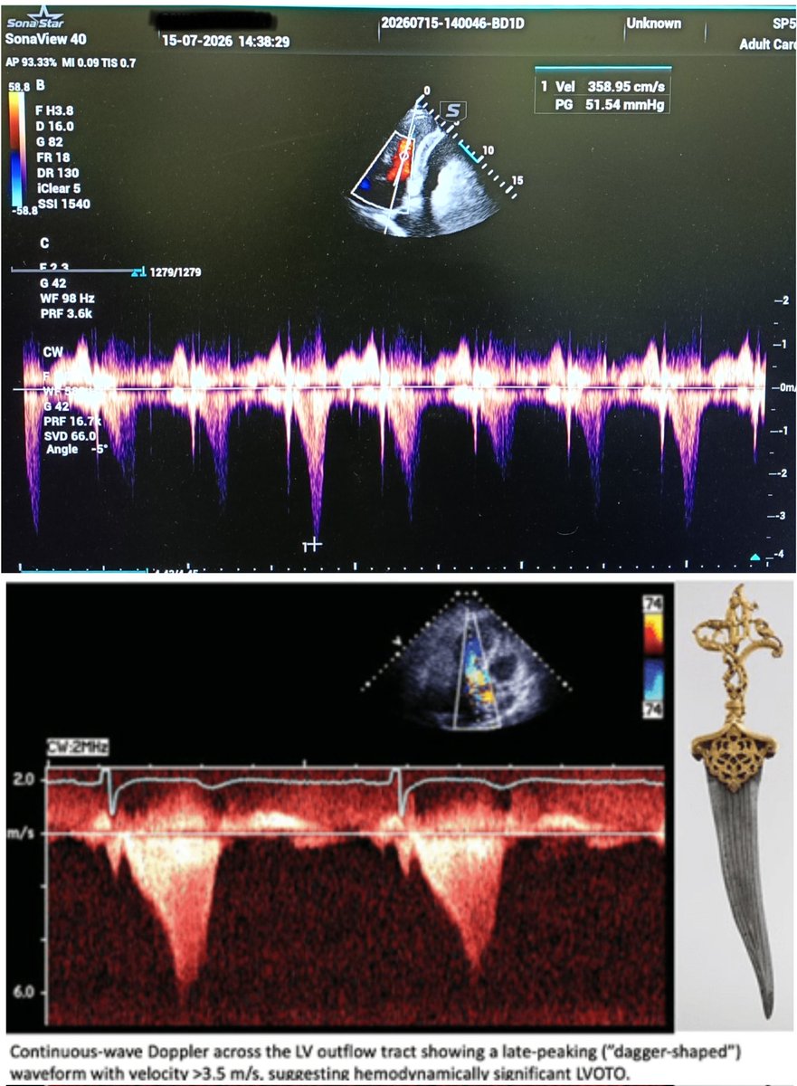 Shamsul_Hi's tweet photo. Significant Mid cavitary gradient in LVH, Hypovolemic State, severe tachycardia produced in CW has a late systolic peaking.
Don't confuse with  LVOT gradient in HOCM.
1st pic - mid cavitary gradient of 51 mmHg in a patient with concentric LVH.
2nd pic - 🗡️ shaped CW,in HOCM. https://t.co/VHNpbTeFII