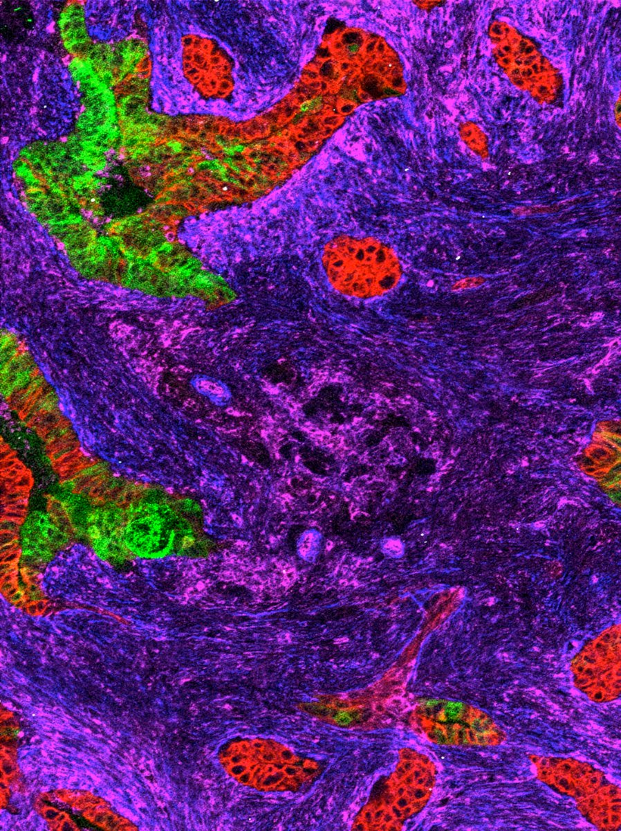 Aiims1742's tweet photo. #PancreaticCancer on cover of @CR_AACR. 
New study from @hopkinskimmel on fibroblasts regulating cancer cell lineage state.
Cancer-Associated  Fibroblasts Promote Epithelial–Mesenchymal Transition and Classical to  Basal Subtype Shift in Pancreatic Cancer
https://t.co/6UnOduP3Xm https://t.co/eDRcAstWrN