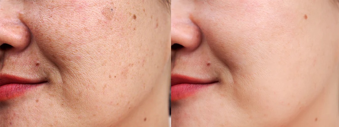 trend_sassy's tweet photo. Hyperpigmentation Brampton
Fade dark spots & achieve an even skin tone.
π https://t.co/Us7FLfTle7
βοΈ 647-532-2600
#trendsassy #HyperpigmentationBrampton #BramptonSkinClinic #SkinCareBrampton #PigmentationTreatment #DarkSpotRemoval #EvenSkinTone #RadiantSkin #HealthySkin https://t.co/VlJCswVL2m