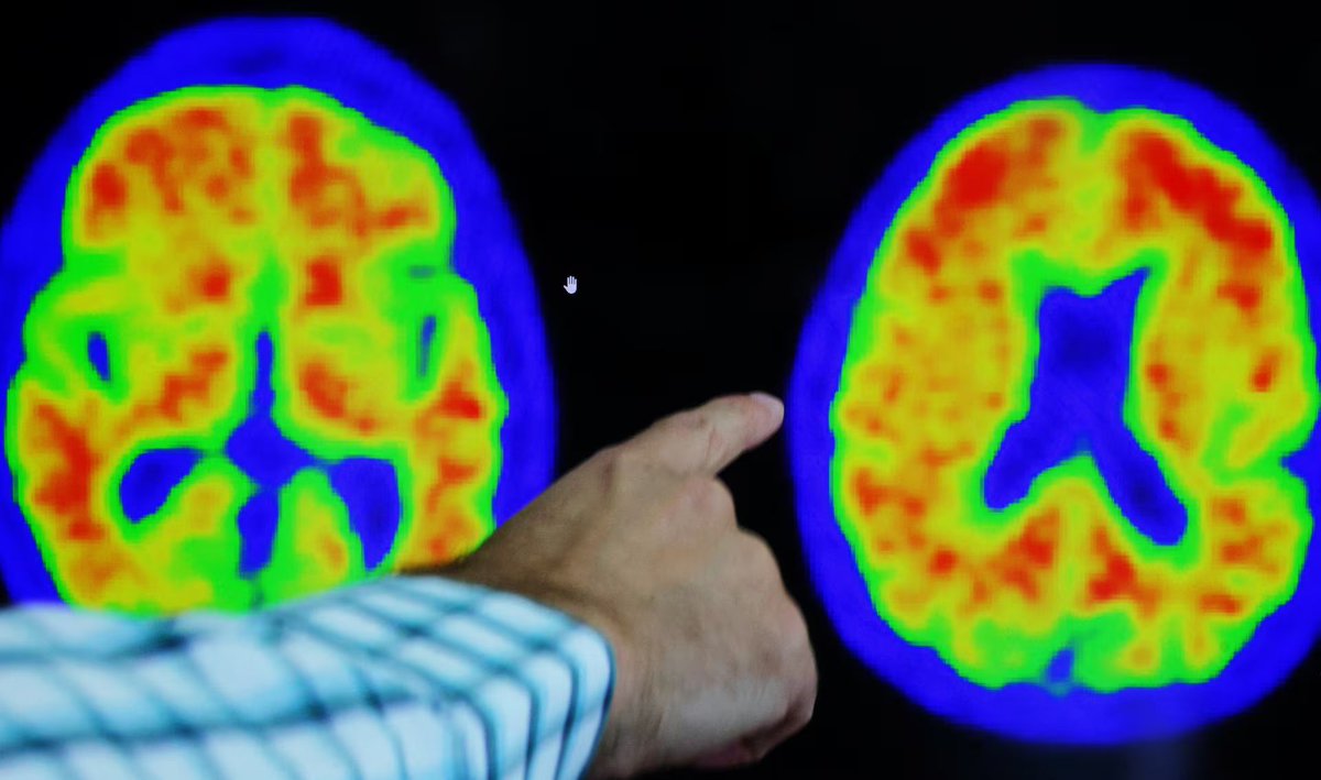 ahier's tweet photo. Biogen's Alzheimer's drug lowers toxic protein, but results were mixed 

https://t.co/qy3iw0aY0s https://t.co/frNyELTBTL