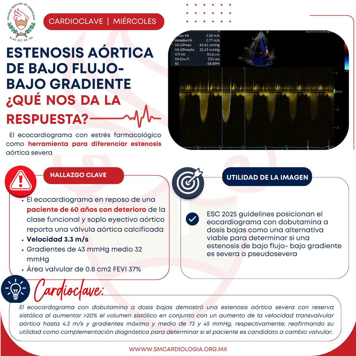 smexcardiologia's tweet photo. 🫀 #CardioClave | Estenosis aórtica de bajo flujo - bajo gradiente: ¿qué nos da la respuesta?
Cuando el ecocardiograma en reposo no permite definir con certeza la gravedad de la estenosis aórtica, el ecocardiograma con dobutamina a dosis bajas se convierte en una herramienta clave para diferenciar una estenosis severa de una pseudosevera y orientar la decisión terapéutica.
📚 Conoce este caso clínico y descubre cómo la imagen multimodal aporta información esencial para identificar a los pacientes candidatos a reemplazo valvular.
👩⚕️ Dra. M. Fernanda León Blanchet @dra.mfernandablanchet
👩⚕️ Dra. Gabriela Urriza Cerezo @gabyurriza
🏥 Hospital Regional "Licenciado Adolfo López Mateos"
#SociedadMexicanaDeCardiología #CardioClave #Ecocardiografía #ImagenCardiovascular #EstenosisAórtica
