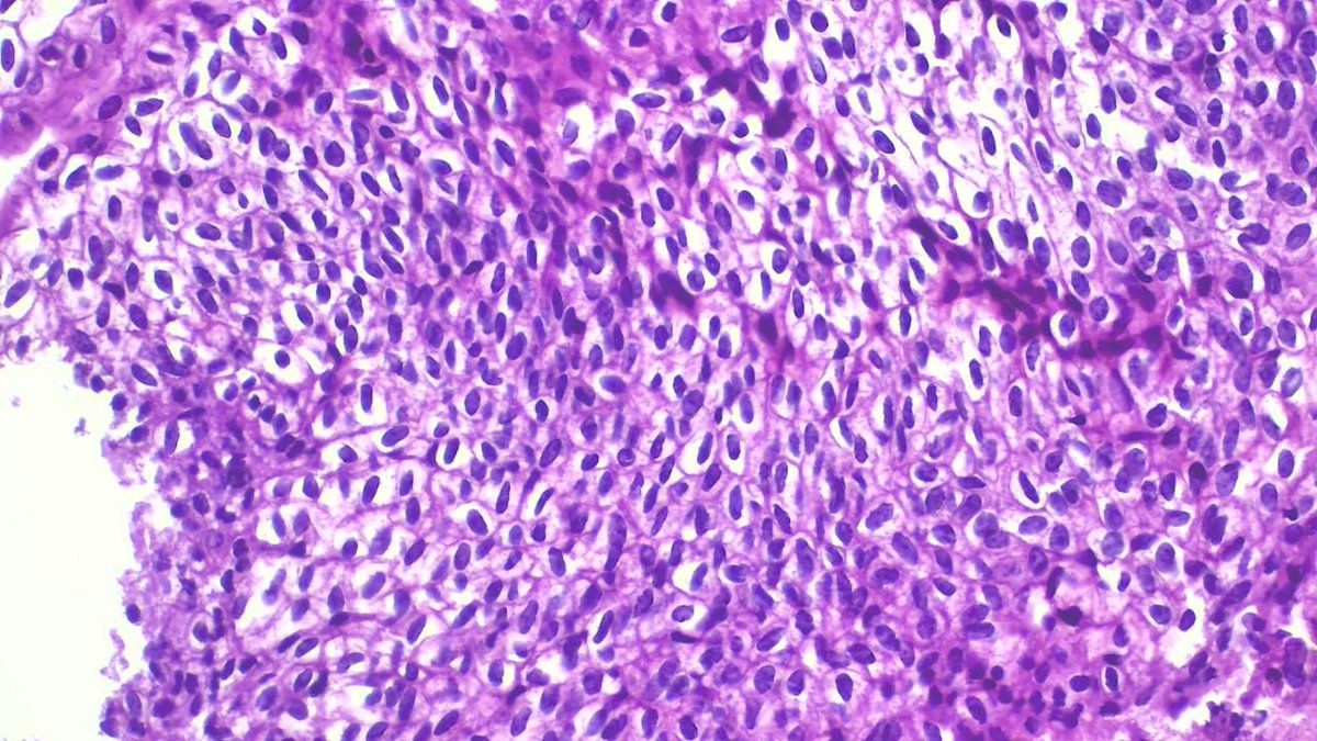 IbrahimManff's tweet photo. 57-year-old female. Cervical biopsy.
Looks worrisome at first glance… but is this really CIN?
What’s your diagnosis? Would you order p16/Ki-67?
#Pathology #PathTwitter #GynPath https://t.co/Z0C14PYMYb