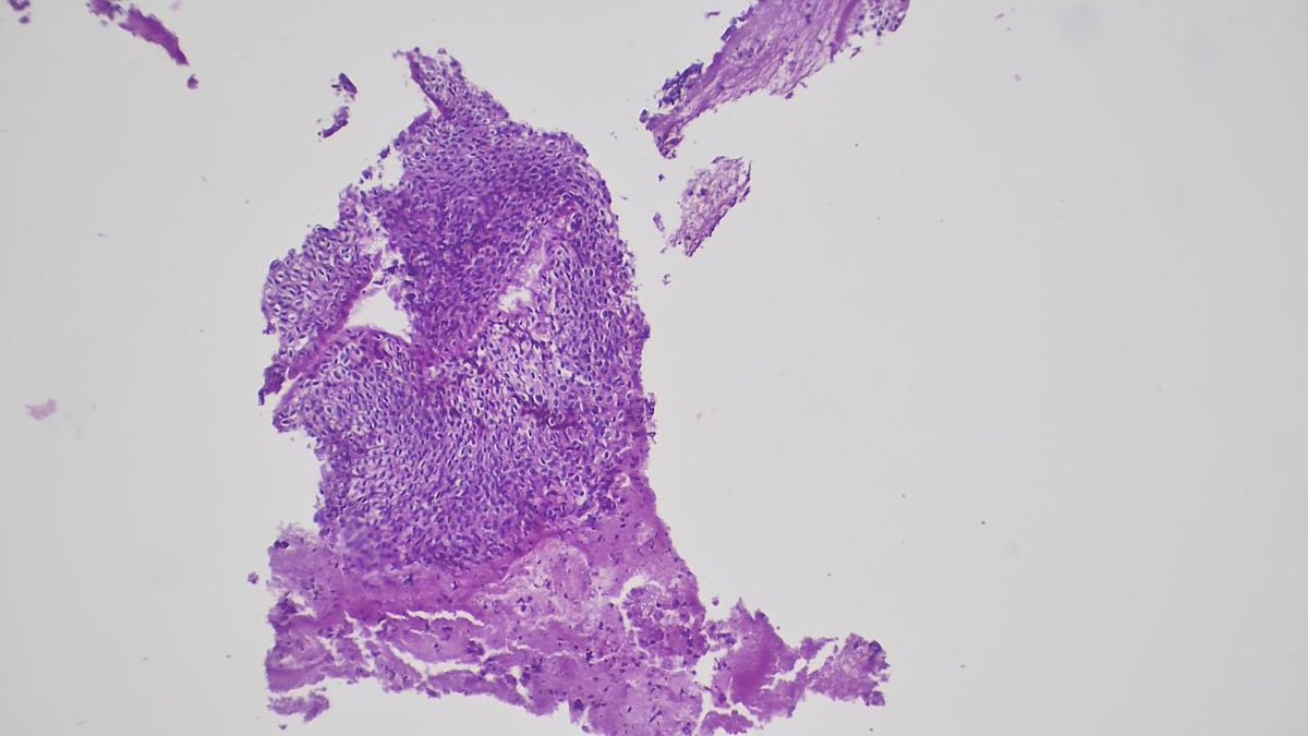IbrahimManff's tweet photo. 57-year-old female. Cervical biopsy.
Looks worrisome at first glance… but is this really CIN?
What’s your diagnosis? Would you order p16/Ki-67?
#Pathology #PathTwitter #GynPath https://t.co/Z0C14PYMYb
