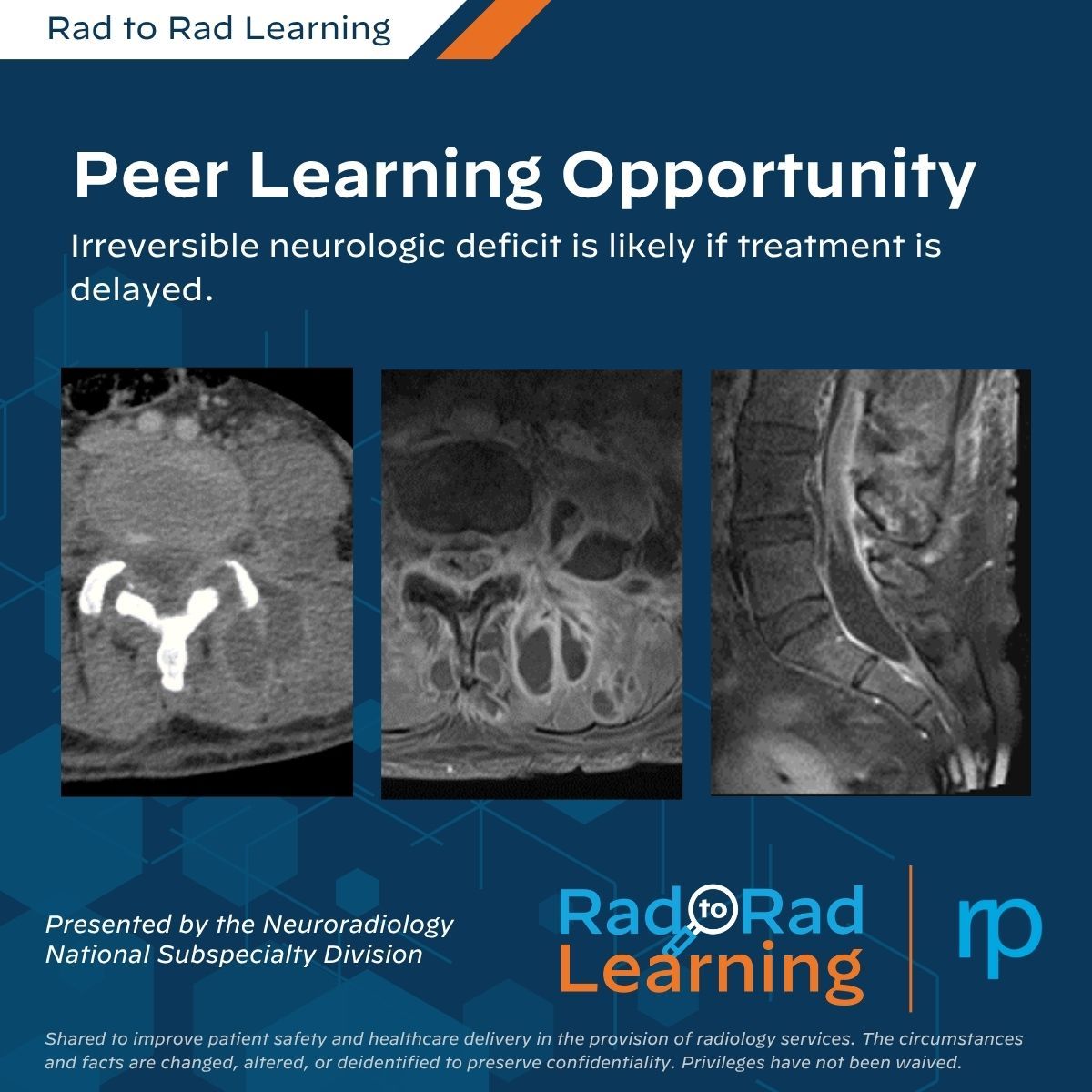 Rad_Partners's tweet photo. New #PeerLearning Case: Epidural Abscess

🔔Delayed diagnosis can lead to irreversible neurologic deficits.

Review key imaging findings and practical insights, including why epidural abscess can occur without discitis.

Explore the #neurorad case: https://t.co/Od8M1RLL2r https://t.co/2NvofGyvUh