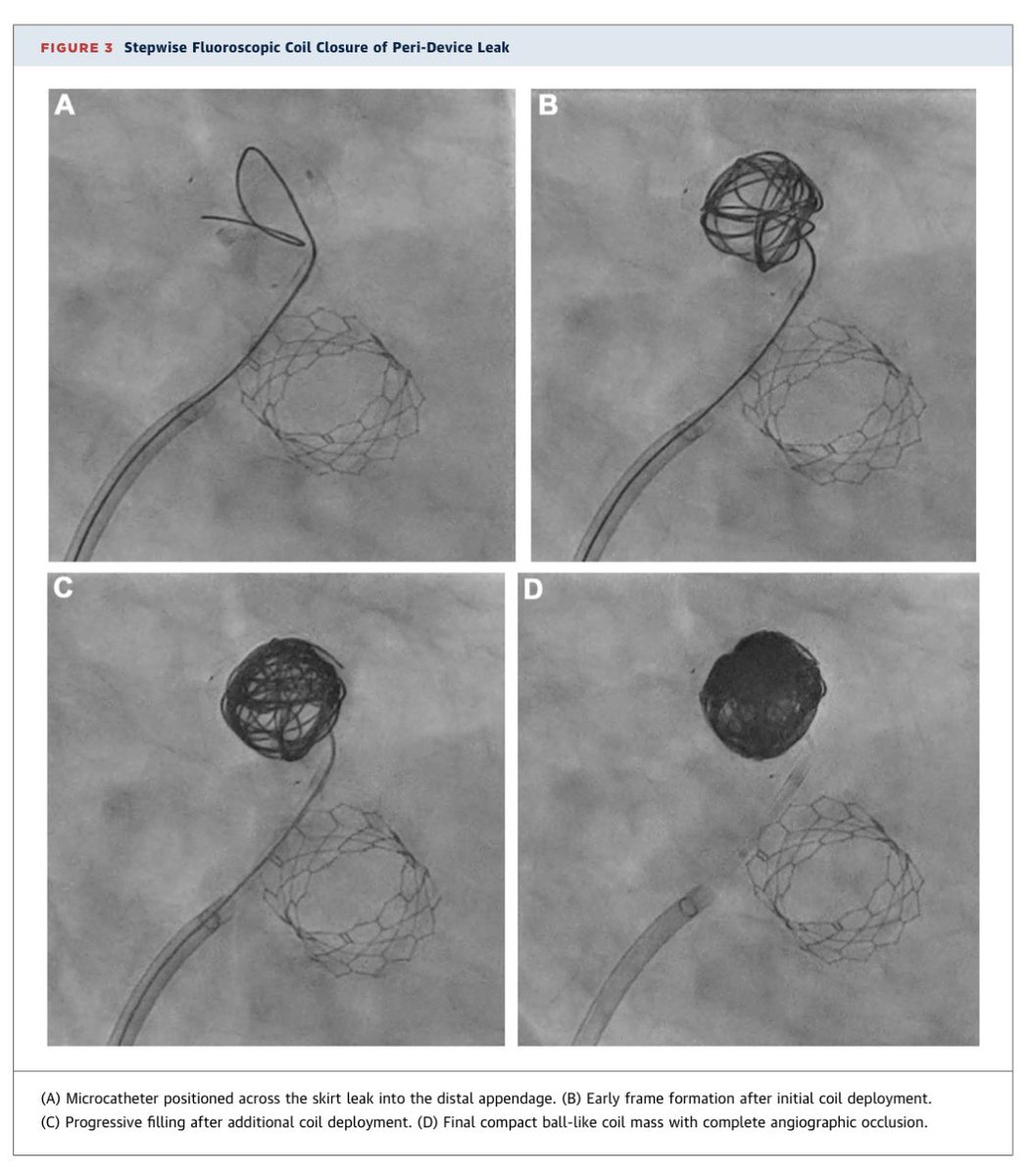 ArturoGiacaman's tweet photo. Staying in World Cup mode—and getting ready for Sunday’s 🇦🇷 vs 🇪🇸 final—here’s JACC: Case Reports in full soccer mode: a “soccer ball” coil closure of an LAAO peri-device leak ⚽️
@engelpedro 🇵🇾 @PedroMDMSc 🇨🇱 @GKFram @JACCJournals @ACCinTouch 

https://t.co/vcqb2lwNzU https://t.co/vAQd4WYWD1