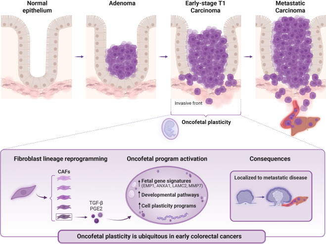 Cancer_Cell's tweet photo. High-plasticity oncofetal cell states in early pre-metastatic colorectal cancer https://t.co/r1gR748Ddx https://t.co/p57XTASttU