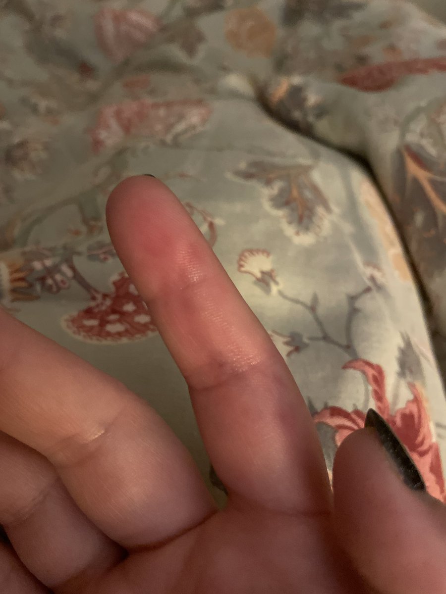 mysweetpains's tweet photo. doing so good i’m biting marks into my fingers to keep from crying!! you can even see where i popped a blood vessel https://t.co/HFMvxVBjXJ