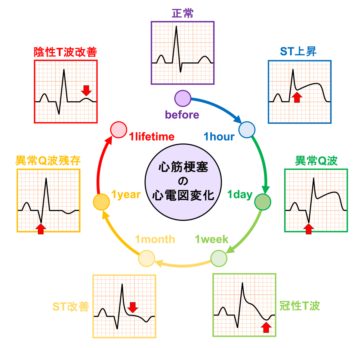 sindenzu1's tweet photo. 心筋梗塞のおおよその時間経過による心電図変化 https://t.co/lauii2bUXN