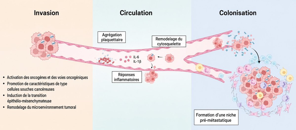 tatiann69922625's tweet photo. Le microbiote dans la cascade métastatique tumorale : nouvelles données concernant l’invasion, la circulation et la colonisation

▶️ Le microbiote pourrait influencer les métastases cancéreuses et a été associé à plusieurs étapes de la cascade métastatique.

▶️ Plusieurs taxons microbiens, notamment Fusobacterium nucleatum, Bacteroides fragilis entérotoxigène et Escherichia coli, sont liés à la progression métastatique par le biais de différents mécanismes dans des contextes spécifiques.

Illustration schématique de la manière dont le microbiote peut intervenir à différentes étapes de la métastase tumorale, notamment l’invasion, la circulation et la colonisation.

Au cours de l’invasion, le microbiote peut renforcer le pouvoir invasif des cellules cancéreuses 
en activant des oncogènes et des voies oncogéniques, en favorisant l’apparition de caractéristiques de type cellules souches cancéreuses, en induisant une transition épithélio-mésenchymateuse et en remodelant le microenvironnement tumoral.

Au cours de la circulation, le microbiote peut influencer la progression métastatique en favorisant les réponses inflammatoires, 
en induisant l’agrégation plaquettaire et l’hypercoagulation, et en renforçant la résistance à la contrainte de cisaillement des fluides 
via le remodelage du cytosquelette.

Au cours de la colonisation, le microbiote peut contribuer à la formation de niches prémétastatiques 
et ainsi favoriser l’implantation et la croissance des métastases dans des organes distants.
@SabinehazanMD