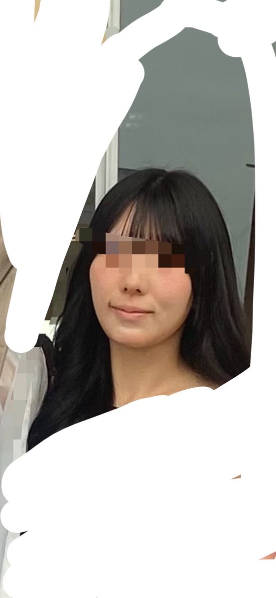 me66me_'s tweet photo. オトガイ形成＋中抜き DT2週間

1.2枚目 他撮りbefore after
3.4枚目 鏡越し外カメ

短縮8mm前進7mm！

なぜか弟にだけバレたけど親友達にもバレてない！ご飯はなんでも食べれる(かぶりつく系はちぎりながらだけど)

人生で初めて人から「顔ちっさい」って言われて骨切ったかいあったー 歯列矯正する https://t.co/FZHR7ldCHK