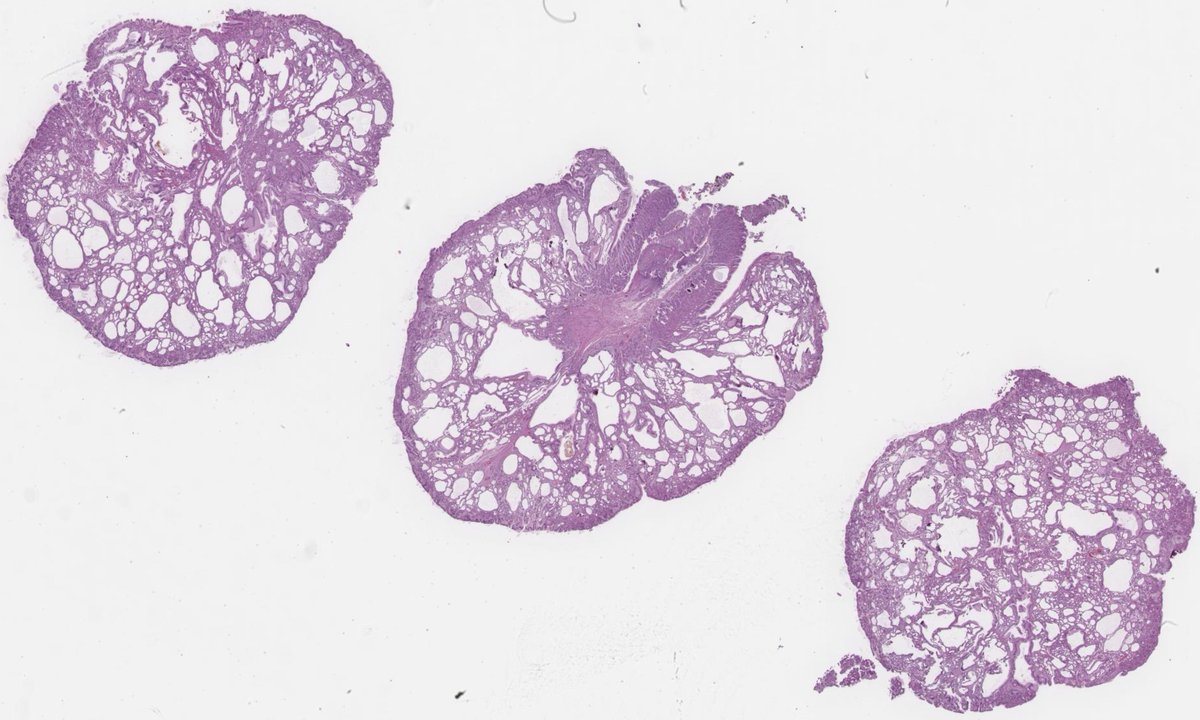 nEqvrXbmCvVyVNI's tweet photo. Fundic gland polyp and the screenshots are from WHO Classification of Digestive System Tumours 6th Edition online. According to it, cyctically dilated glands containing greenish material represent a characteristic feature in this type of polyp. Can anyone explain the reason? https://t.co/bJqKkRltIk
