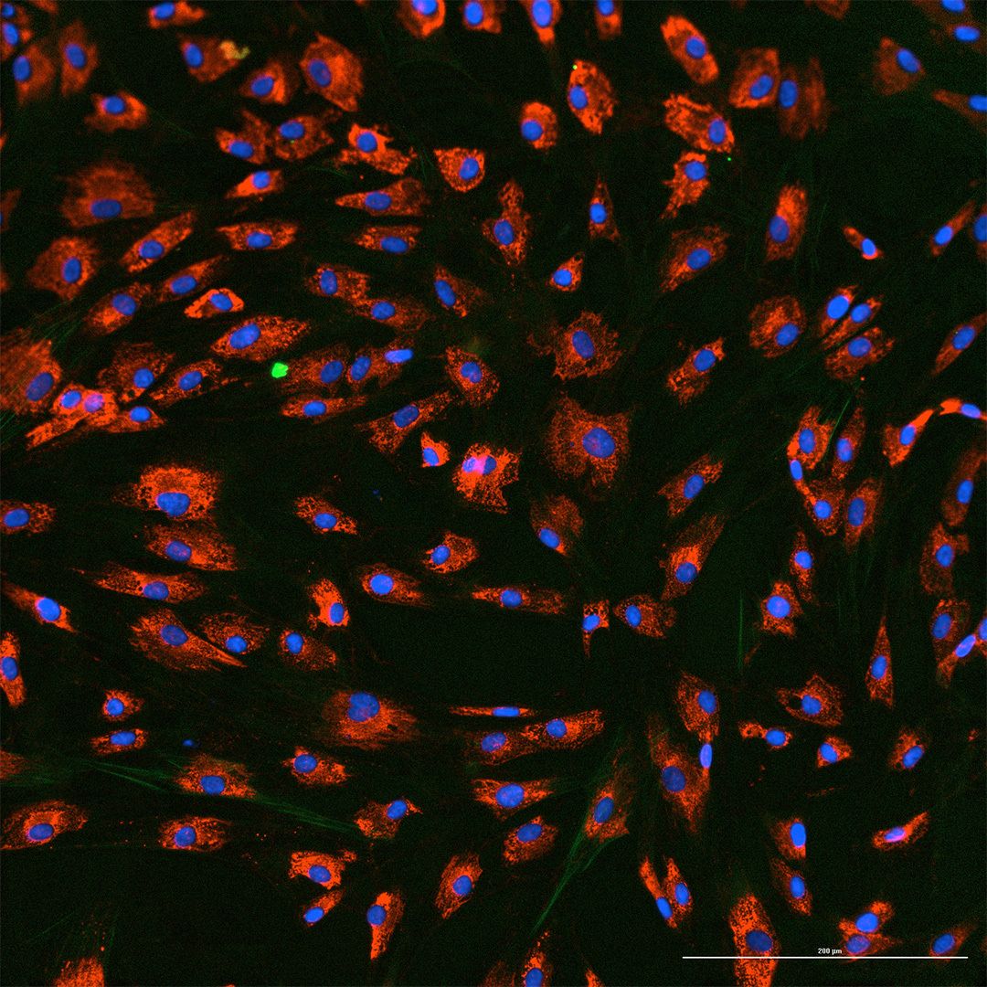 JCI_insight's tweet photo. Spotlight: The first to establish alanine metabolism as a potential therapeutic target for fibrotic diseases👇
https://t.co/Q9KokgKa6K

William M. Oldham @wm_oldham & team @BrownMedicine report scar-forming cells in #PulmonaryFibrosis rely on alanine as a metabolic building block and simultaneously blocking its synthesis and uptake suppresses #fibrosis in human lung tissue.

The images: Markers of myofibroblast differentiation (α-SMA and COL1A1) in IPF patient-derived cells under conditions of TGF-β stimulation (1/2) and impaired alanine metabolism (2/2). 
with @EdyKim5