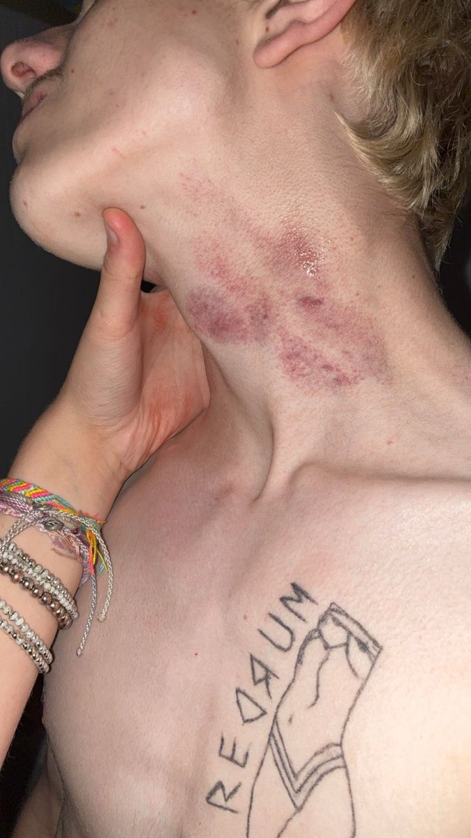 misfitvv's tweet photo. Some pics of my good puppy boy who begged for mommy to mark him up! he says it hurts because i bite so hard yet he still begs like a good little boy to be marked up by mommy. mommys bestest boy. #domfem #nsfw #goodboy #helovesthis
#marks https://t.co/RSmPinfJ1d