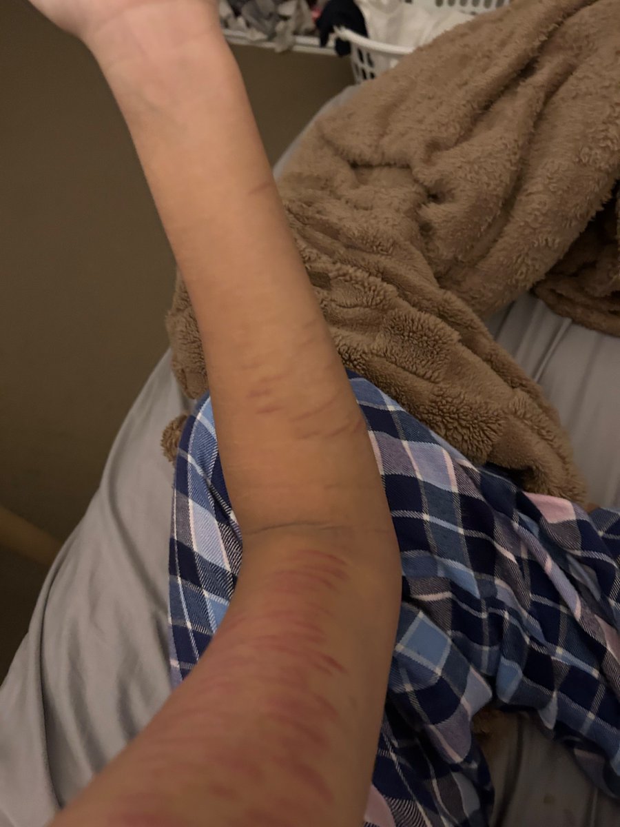 aceofblvdes's tweet photo. full body scar checj bc i miss cuttign https://t.co/7WWgwk8nE3