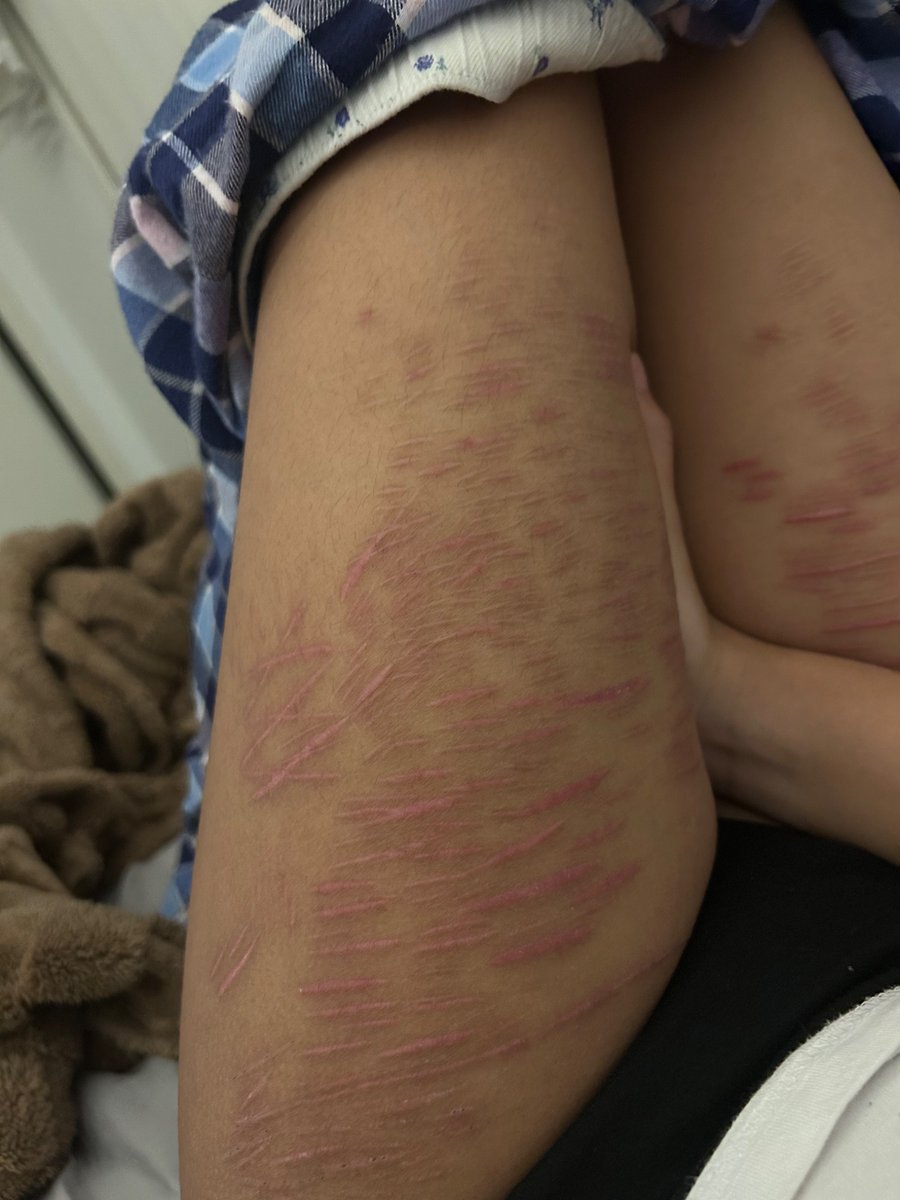 aceofblvdes's tweet photo. full body scar checj bc i miss cuttign https://t.co/7WWgwk8nE3