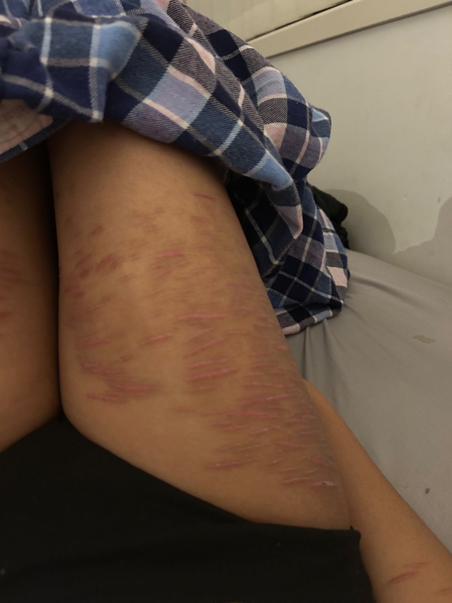aceofblvdes's tweet photo. full body scar checj bc i miss cuttign https://t.co/7WWgwk8nE3
