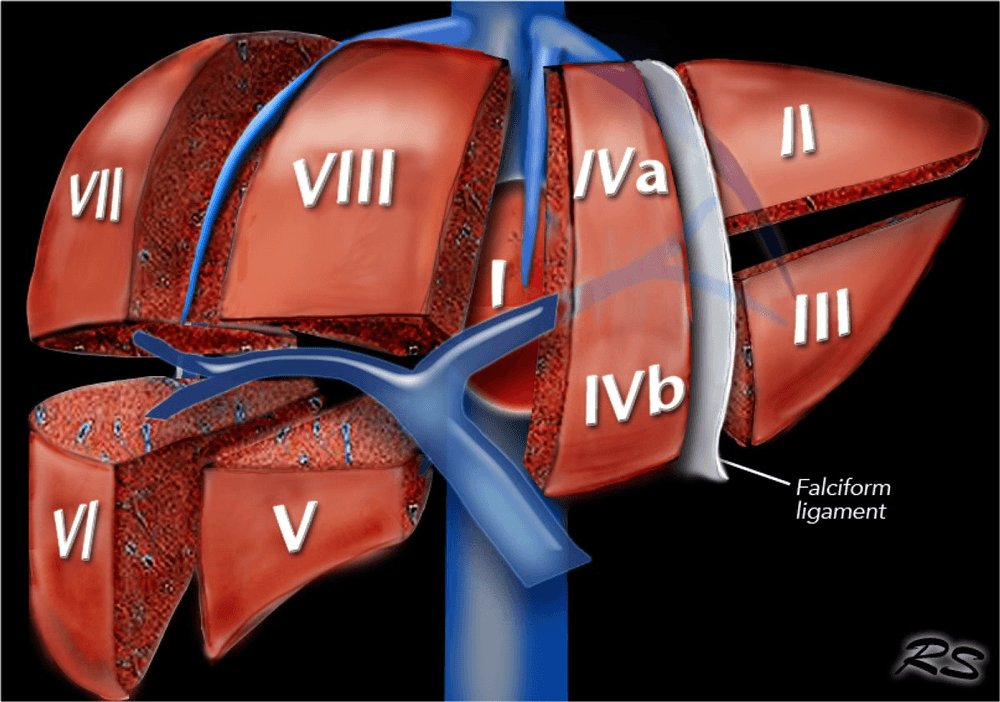 EndoCollabcom's tweet photo. Couinaud segments map the liver into 8 functional units, each with its own portal inflow, hepatic venous outflow, and biliary drainage.
 
Know the segment before you interpret imaging, plan resection, or discuss vascular anatomy with surgery. https://t.co/erb8fH3Mn9