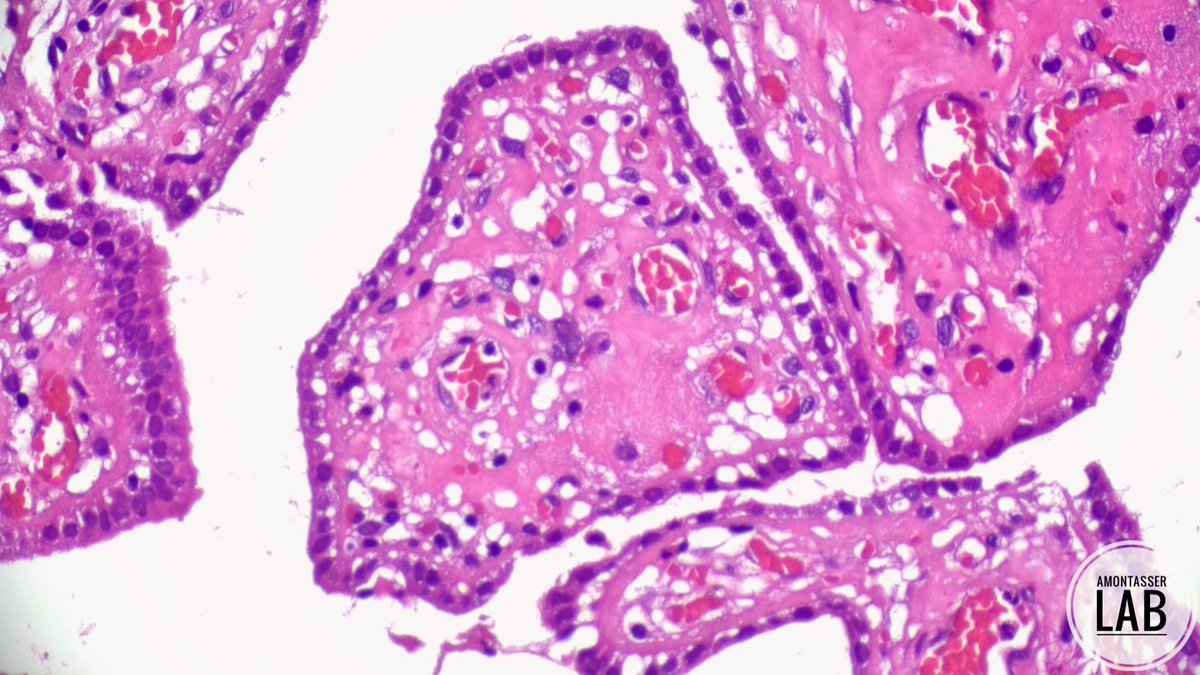 AMontasserMD's tweet photo. Nephrogenic Adenoma
B E A U T I F U L 🥹
#GUpath #PathTwitter #PathX #pathology