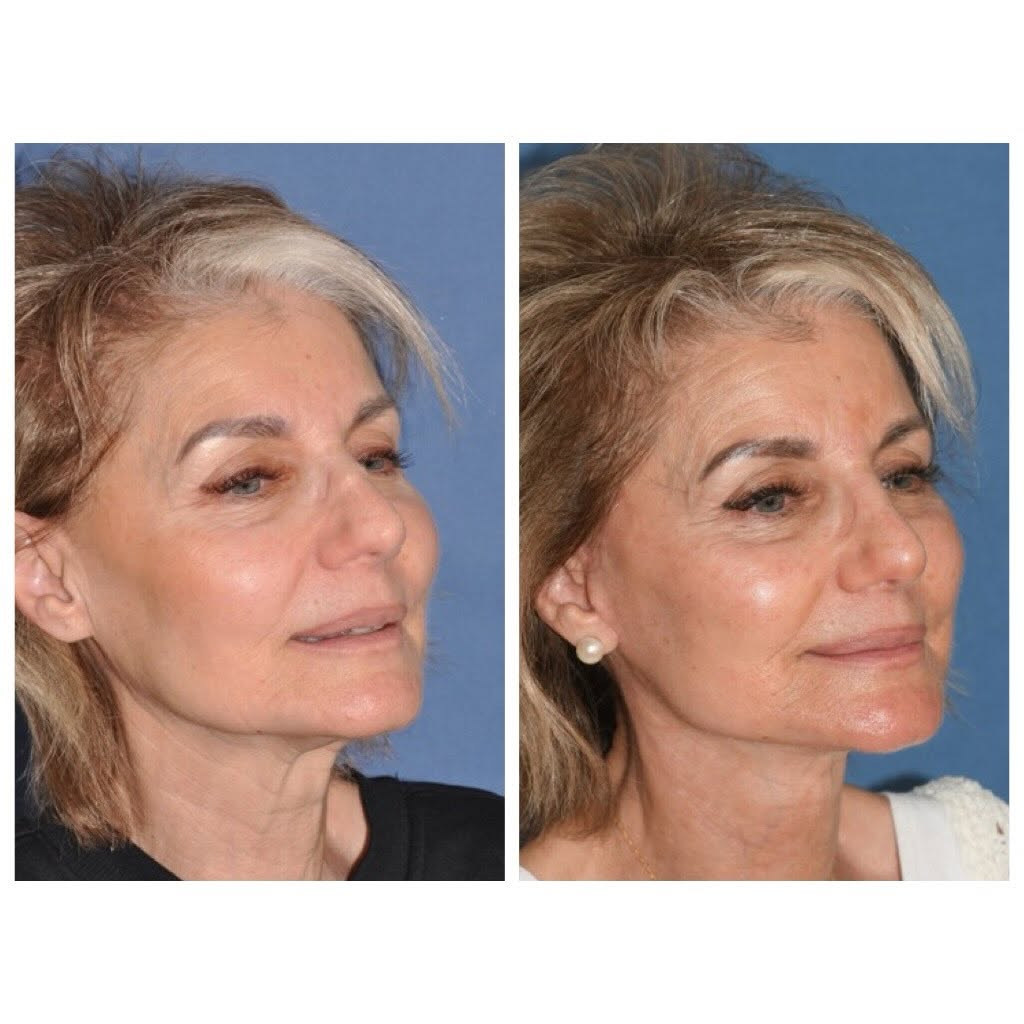 JenniferTsai01's tweet photo. Deep plane face and neck lift and minor rhinoplasty to she bumps.
She looks beautiful and “turned back time”.
Subtle changes, not drastic unnatural solutions, are my philosophy.
So happy for her and thank you so much for allowing us to share!
#facelift #deepplanefacelift https://t.co/5qt96tArJz