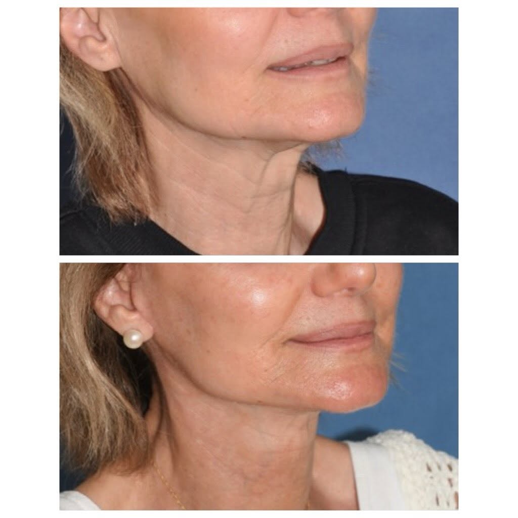 JenniferTsai01's tweet photo. Deep plane face and neck lift and minor rhinoplasty to she bumps.
She looks beautiful and “turned back time”.
Subtle changes, not drastic unnatural solutions, are my philosophy.
So happy for her and thank you so much for allowing us to share!
#facelift #deepplanefacelift https://t.co/5qt96tArJz