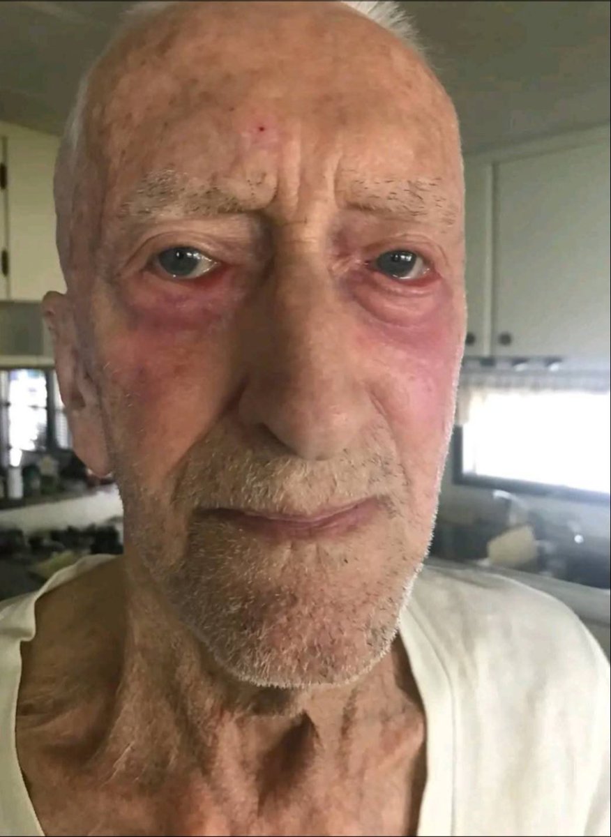 JeremyScottt12's tweet photo. IVERMECTIN Topical Cream Testimonial - 88 year old Alberta farmer with  skin Cancer has 4 tubes of Ivermectin paste sent to him by his son

More and more Topical Ivermectin testimonials are starting to come in...

88 year old farmer in Alberta was diagnosed with skin cancer 

His son sent him 4 tubes of Ivermectin paste.

"He called this morning to report that after a month, he has used three tubes and has applied three times a day. The cancer has cleared up..."

Every type of skin cancer can be treated with Topical Ivermectin: basal cell carcinoma, squamous cell carcinoma and yes, even melanoma.

You can start to see a response visually fairly quickly...within weeks!
Follow me for more incredible stories like this.

#ivermectin #cancercure