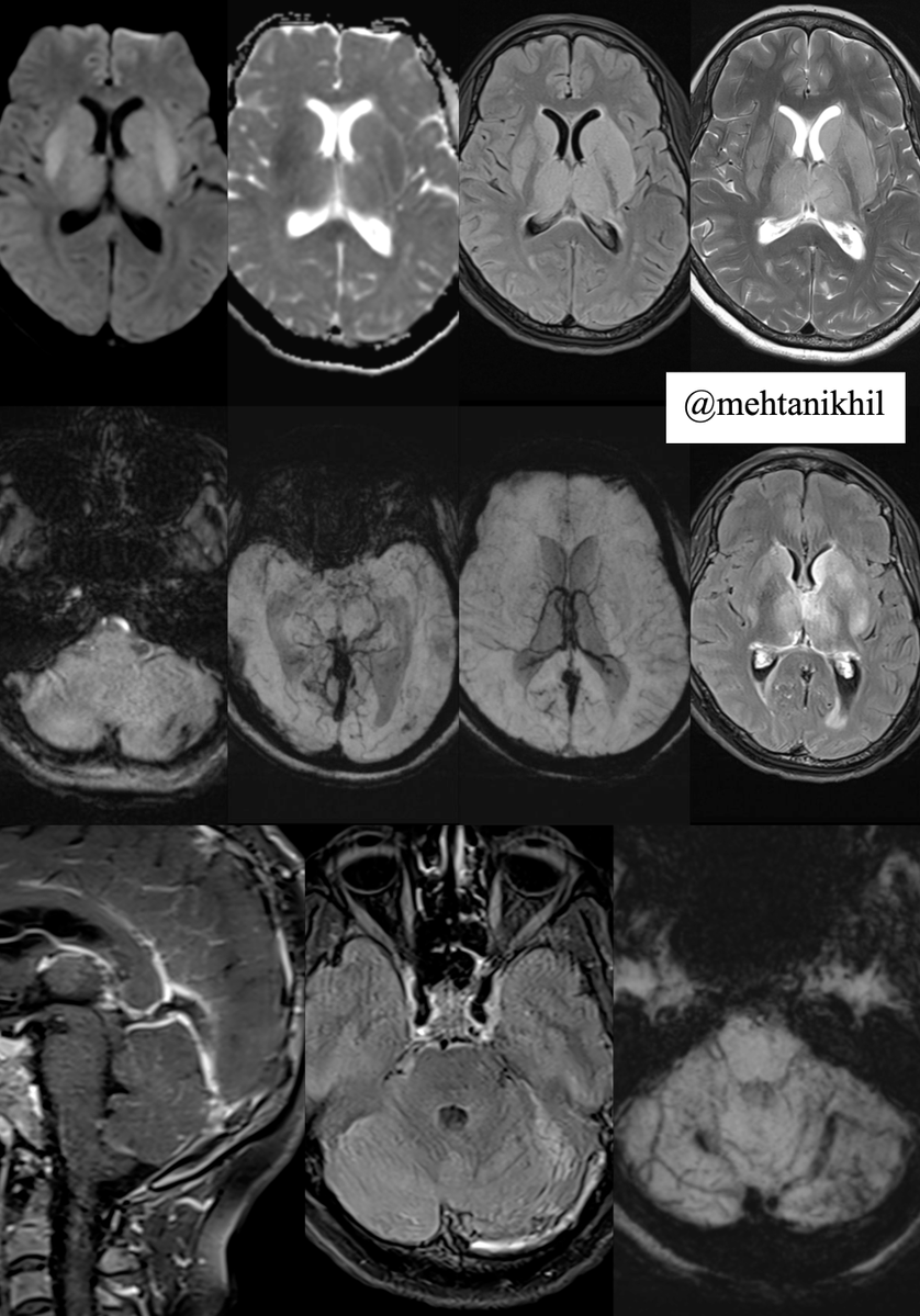 Nirmal Pandey MD DM Neurologist tweet media