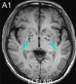 DocNavarrow's tweet photo. 🤵A 37-year-old man presents with 3 weeks of progressive headache, intermittent fever, vomiting, and recent confusion. Brain MRI is performed after clinical deterioration. 

🏥What is the most likely diagnosis? https://t.co/cqtR7ZQVSf