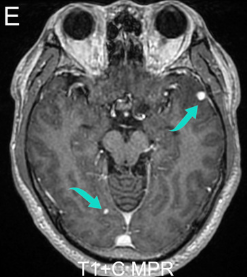 DocNavarrow's tweet photo. 🤵A 37-year-old man presents with 3 weeks of progressive headache, intermittent fever, vomiting, and recent confusion. Brain MRI is performed after clinical deterioration. 

🏥What is the most likely diagnosis? https://t.co/cqtR7ZQVSf