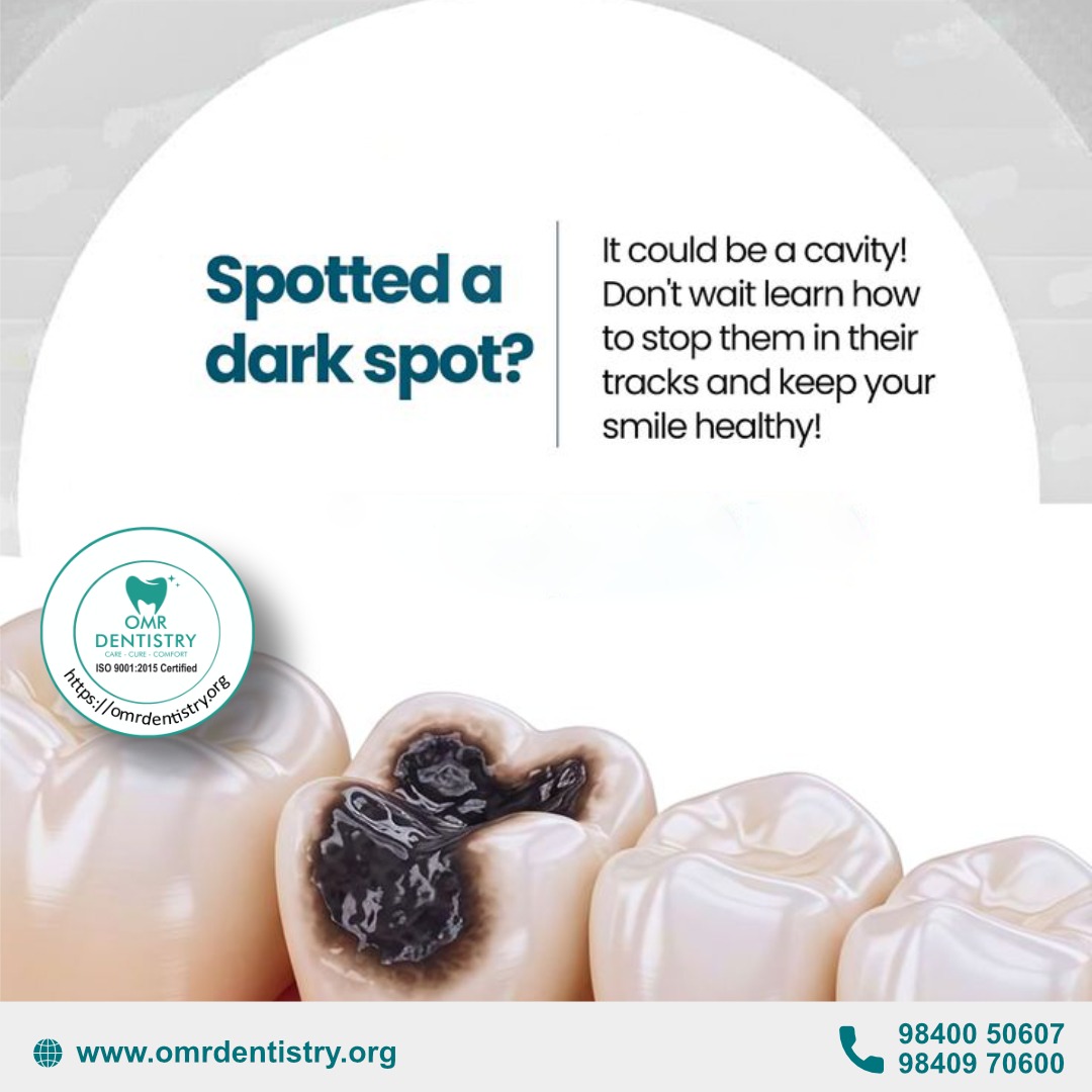DentistryOmr's tweet photo. 🦷 A tiny dark spot today could become a bigger problem tomorrow. Early detection and timely treatment can save your tooth and your smile. Don't ignore the signs—schedule your dental check-up today! ✨ https://t.co/nbICPz9PcE