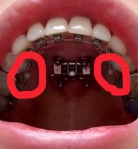 REY_PLASTIC's tweet photo. 🗓️2026/7/17の歯(13回目の調整)

玉みたいなグルー？をつけて
さらに前に出す作業した！(上下)

先生には、
もう前に出さなくて良いタイミングで
ストップ言ってねって言われてる！

ほんの数ミリだけど隙間空いてきて
だんだん前に出てきてる感覚ある！

年内までには前に出す作業おわるかなぁ🥹🫧 https://t.co/k1sIYhXzqq