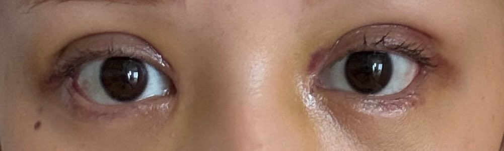 a______c11's tweet photo. 8日目〜だいぶ腫れもあざも引いてきた気がする🥺目がごろごろする〜 https://t.co/5eXXk2remD