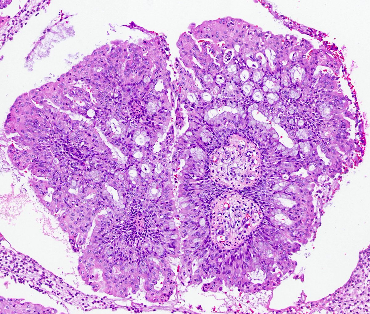 Saroja_DeviG's tweet photo. A cute mixed squamous &amp; glandular papilloma of the lung.

These rare benign tumors show papillary cores lined by glandular epithelium admixed with squamous cells. A good reminder that not every endobronchial papillary lesion is malignant.

#PathTwitter #LungPath #MedTwitter https://t.co/wMIMvaO39v