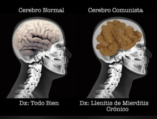 GARCIPAVON's tweet photo. Diagnóstico radiográfico entre dos tipos de cerebros 🧠 👇