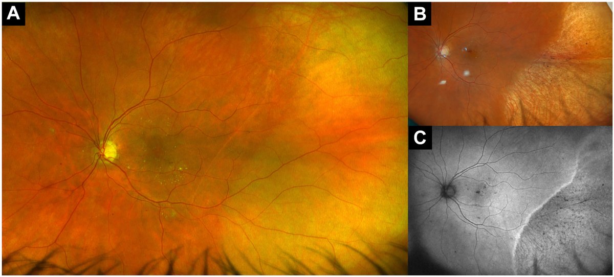 AAOjournal's tweet photo. A 56-year-old woman with diabetic macular edema presented from elsewhere after subconjunctival anesthesia was complicated by inadvertent subretinal injection of 2% lidocaine. Visual acuity dropped to hand motion, and an anterior chamber tap was performed by the injecting provider to lower the intraocular pressure (IOP). The following day, vision recovered to baseline 20/30 with normal IOP, and fundus examination revealed temporal retinal whitening spanning 5 hours, sparing the macula (A). Five years later, fundus examination showed temporal pigmentary changes (B), and fundus autofluorescence demonstrated a hyperautofluorescent demarcation line with adjacent areas of speckled hypoautofluorescence (C). Subretinal injection of lidocaine can cause long-term retinal pigmentary changes, but good visual acuity if the macula is spared. 
https://t.co/hHpaniPwlS
#ophthalmology #retina