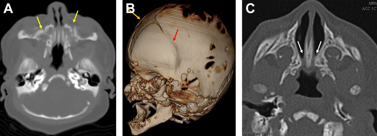 maxilolapaz's tweet photo. 🔹Utility of screening for obstructive sleep apnea (OSA) with the pediatric sleep questionnaire (PSQ) in children with craniofacial anomalies, by #CPCJ

🔸https://t.co/cK4Qk0t6wG   #MAXILOLAPAZ https://t.co/EMlWvEjfoJ