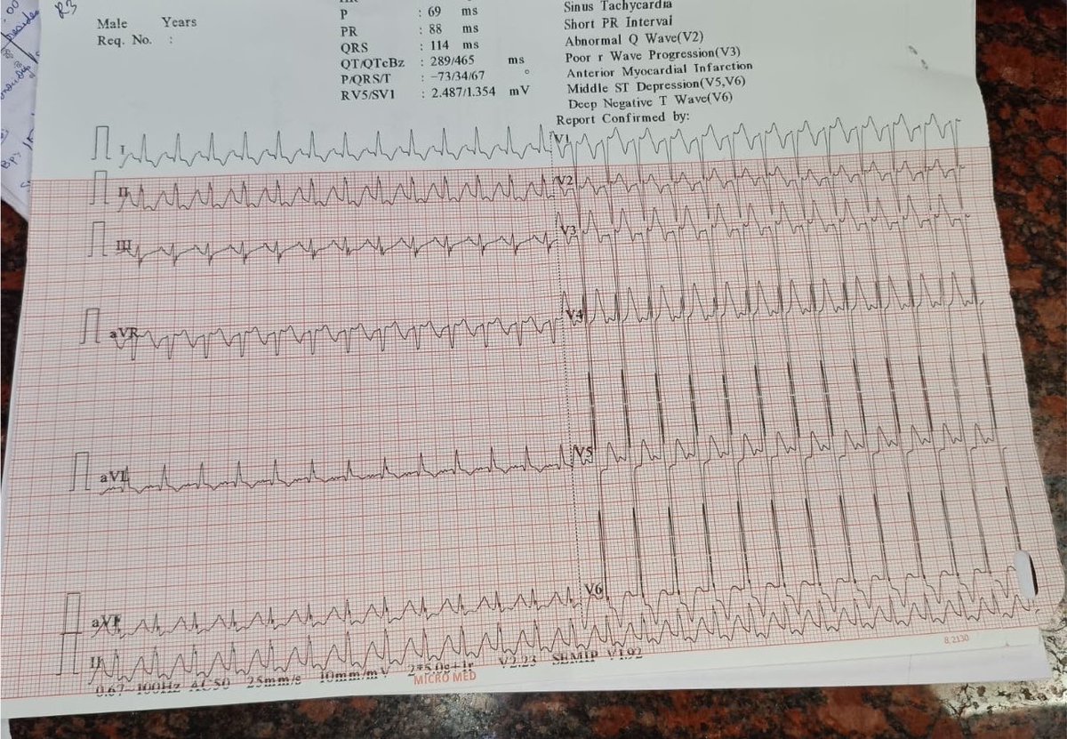 ecg_lover's tweet photo. 49/Male with seizures 
@Ecgloverr @ecgandrhythmRoe @ecgrhythms @DrRazi4 @The_Nanashi_O @Jagdish26039718 @nihar_nayak2 https://t.co/aWbPFHxK0W