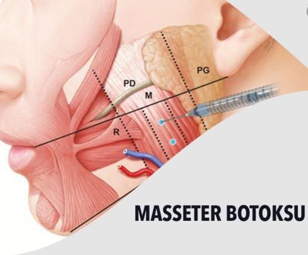 modernklinik's tweet photo. Yanak alt kısmında bulunan çiğneme kasına (masseter kası) belirli noktalardan yapılan botoks enjeksiyonu, kastaki stresi ve aşırı çiğneme kuvvetini ortadan kaldırarak kasta rahatlama sağlayarak geceleri diş gıcırdatma, diş sıkma sorunu ortadan kalkmaktadır. https://t.co/0Q9AQyIXvk