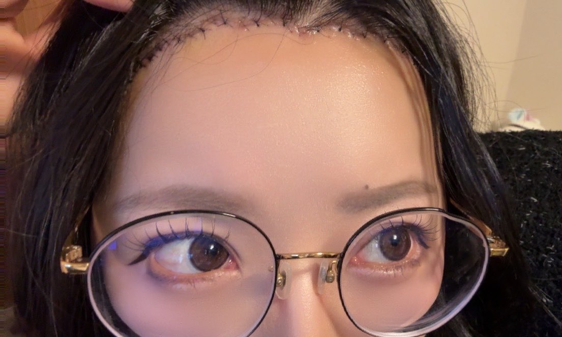 yodomori's tweet photo. おでこ切ってきたよ〜！
頭皮のダメージで禿げるの怖いよ〜！
脱毛予防でボトとかも打って25万くらいだよ〜！
1.3cm切ったよ〜！
ダウンタイム頑張るよ〜🥲 https://t.co/mR0bACygLJ