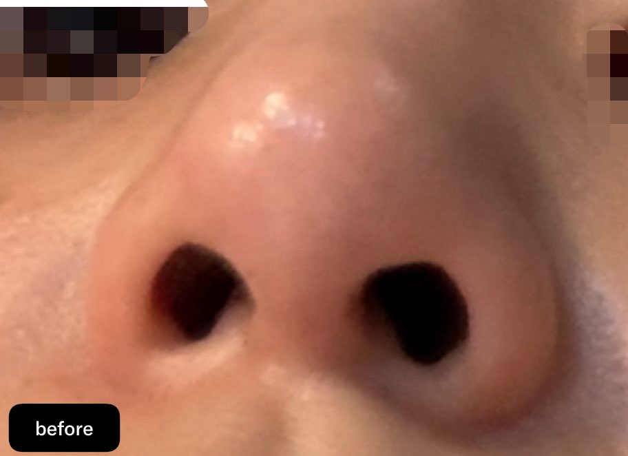 JYe1g's tweet photo. 貴族フィラーから3日 
まだ全体的に鼻、鼻周辺が腫れてて鼻の穴もでかくなってる https://t.co/0yH0EIb5Ih