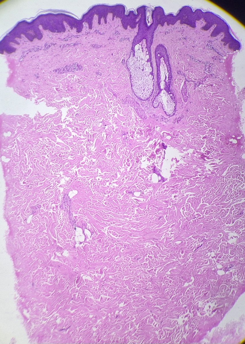 arthy_os's tweet photo. 36/ M, M/L hyperpigmented well defined papules coalescing to plaques over, forehead, retroauricular area, chest, abdomen, arm, forearm.Micro- irregular acanthosis, hyper and parakeratosis, follicular plugging- Pityriasis rubra pilaris. https://t.co/W2jjdFf4hX