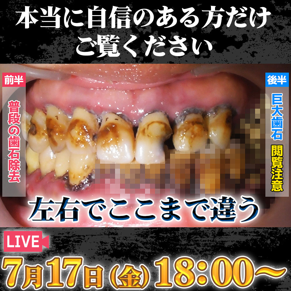 yukithewhite's tweet photo. 18:00からYouTubeライブをします！歯垢や歯石のつきにくい生活習慣を解説しますが、、、閲覧注意⚠️です。

https://t.co/yMaMGcz890 https://t.co/jA2ECJSJHa