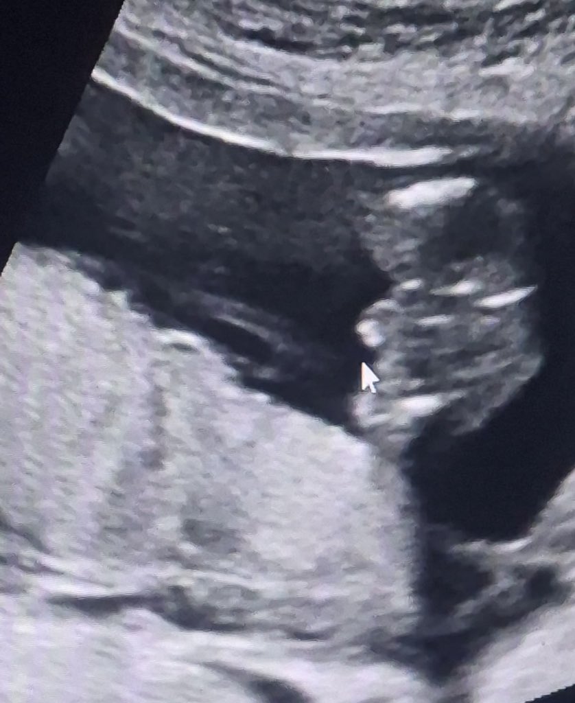 MagmoudMassri's tweet photo. 💔🇵🇸My son will be born in just a few 🚨💔days… and I don’t even have a single diaper for him.

Today, during an ultrasound, the doctor told us that my baby boy is ready to come into this world.

Alhamdulillah for everything, but I swear I have not been able to prepare anything for him.

There is no crib to keep him safe from the rats, no clothes to welcome him, no diapers, and none of the basic things a newborn needs.

I’m sorry, my little one. I’m sorry that you will be born during a war, and that I cannot give you the welcome every baby deserves. I still pray that our situation will change and that one day we can return to the life we had before the war.

If you are able to help, please consider donating any amount, even $5. Your support could help me buy diapers, baby clothes, and a few essential items before he arrives.

Please don’t let him come into this world with nothing. Imagine he were your own child.

Thank you from the bottom of my heart to everyone who donates or shares our story. 🤍https://t.co/02eRteZYDH

If you would like to verify our situation before donating, you are welcome to message me privately. I am happy to arrange a video call and answer any questions you may have.

Thank you for taking the time to read our story and for any support you can offer. 🤍